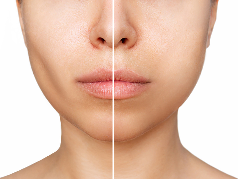 Cheek Enhancement
